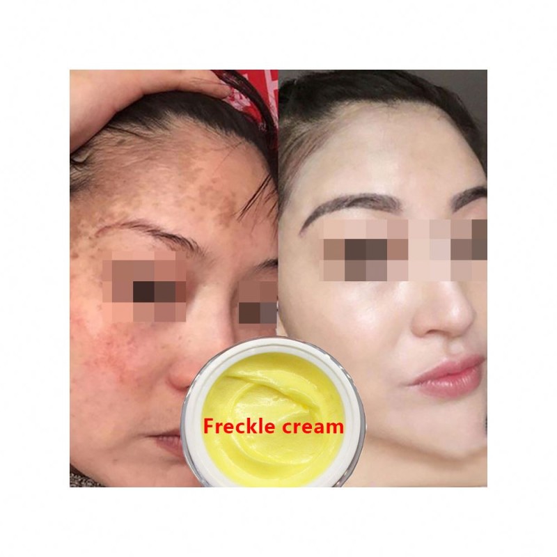 Freckle Removal Cream Supplier - OEM Herbal Plant Extract Dark Spot Corrector