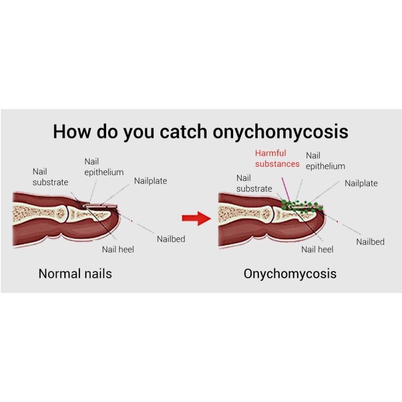 Nail Repair Essence Factory - OEM Fungal Treatment