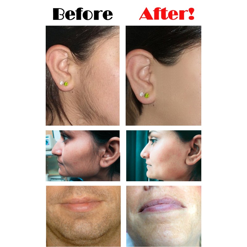 Portable IPL Hair Remover Factory - Bulk Women Men Fast Pain Free Armpits Legs