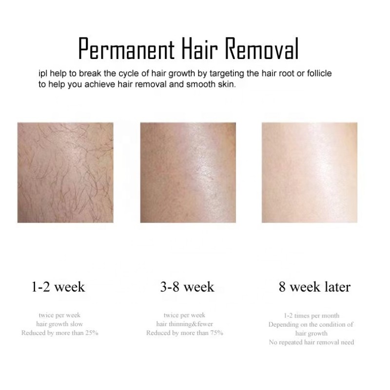 Ice-Cooling Hair Removal Factory - Bulk Safe Long-Lasting Laser IPL Technology