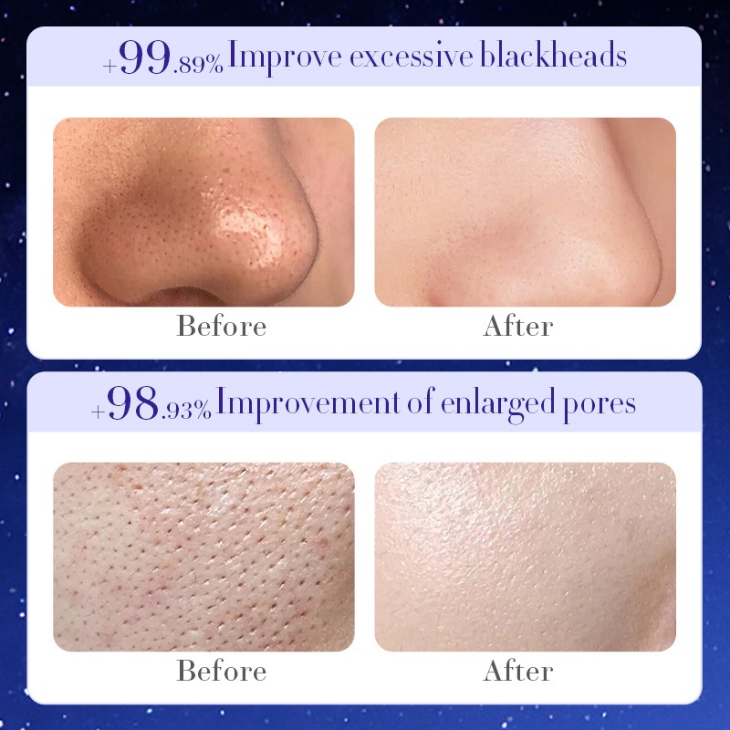 Tearing Mask Factory - OEM Starry Sky Blackhead Removal