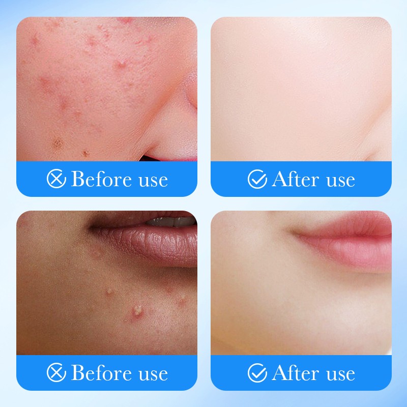 Acne Patch Manufacturer - OEM Hydrocolloid Pimple Stickers