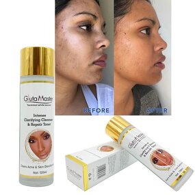 Acne Treatment Toner Manufacturer - Whitening Face