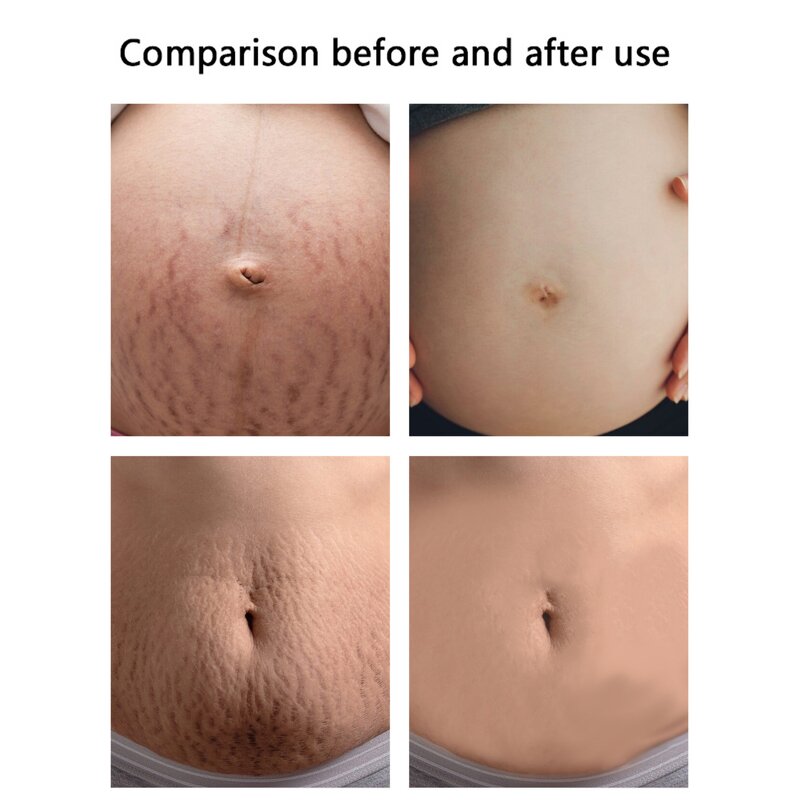 Stretch Marks Set Manufacturer - Effective Removal