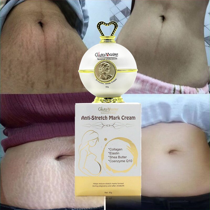 Stretch Marks Cream Manufacturer - High Quality Repair