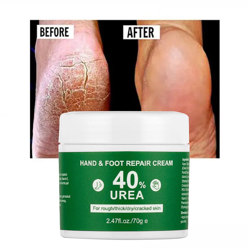 Foot Cream Manufacturer - Dead Skin Remover Urea