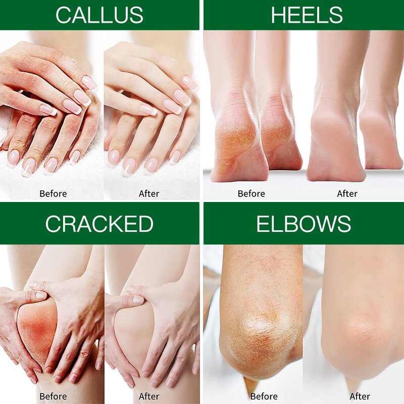 Foot Cream Manufacturer - Custom Anti Crack Shea