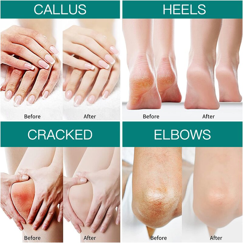 Foot Cream Manufacturer - Redness Dead Skin Removal