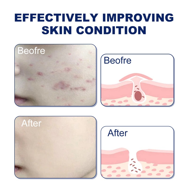 Foam Cleanser Supplier - OEM Hoygi Deep Cleansing Oil Control Water Supplement Mousse