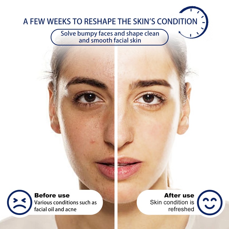 Foam Cleanser Supplier - OEM Hoygi Deep Cleansing Oil Control Water Supplement Mousse