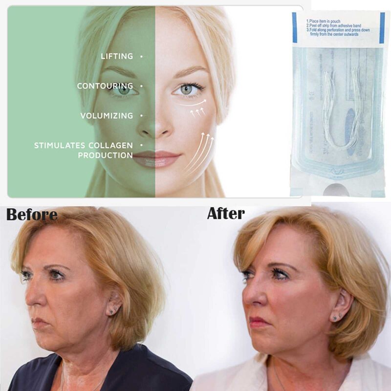 Collagen Threads Manufacturer - OEM No Needle Radar Silk Protein Line