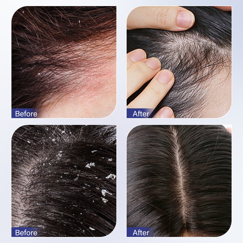 Anti-itching Shampoo Factory - 250ml Folliculitis Cleansing