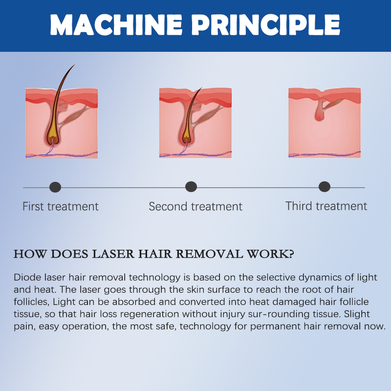 Diode Laser Hair Removal Machine Factory - 2400W 3 Wave 755 808 1064 Price