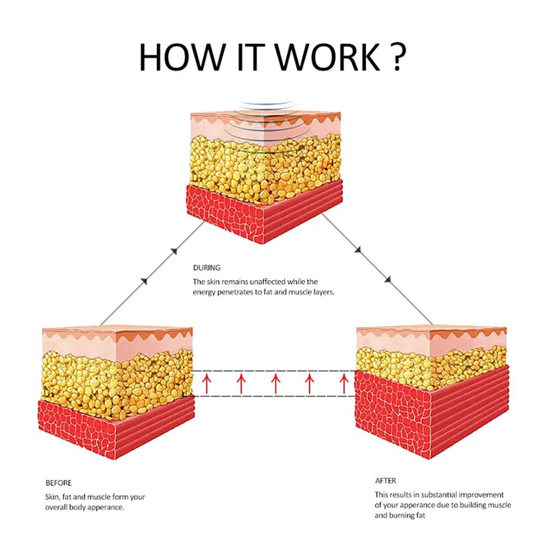 Portable Fat Dissolving Machine Manufacturer - 40k V6 Slimming Instrument RF Thermal Skin Care