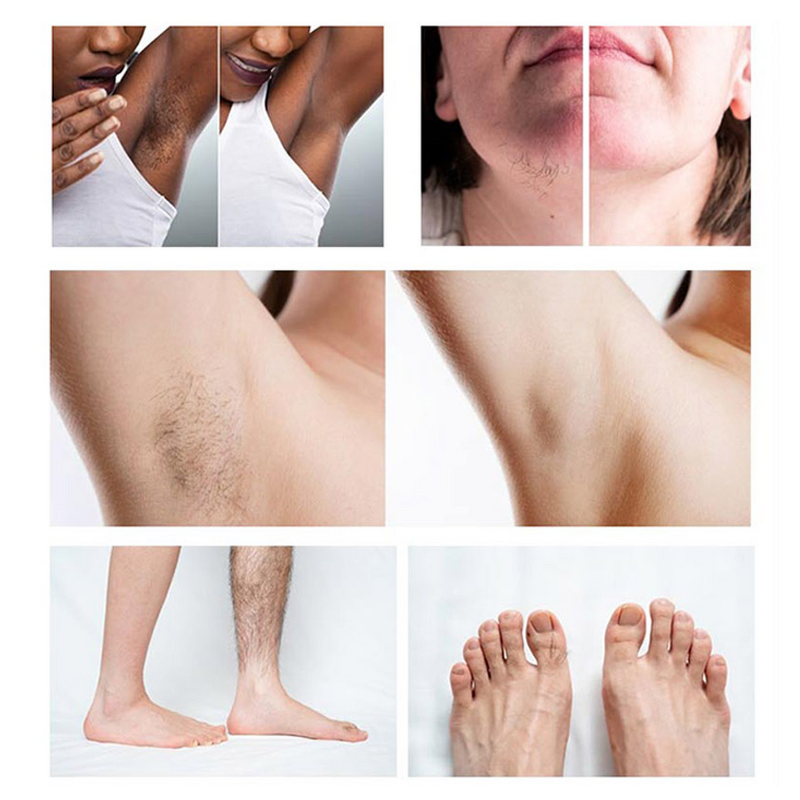 Diode Laser Hair Removal Machine Manufacturer - G Laser Best Professional 755 808 1064nm