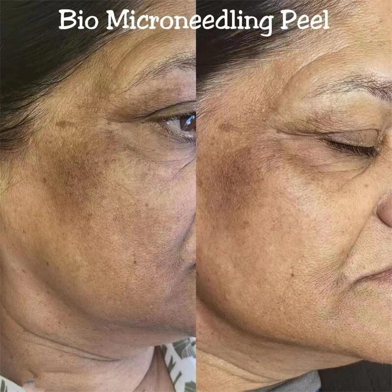 Bio Spicule Sponge Manufacturer - G Microneedle Peel Acne Treatment Non-invasive Algae