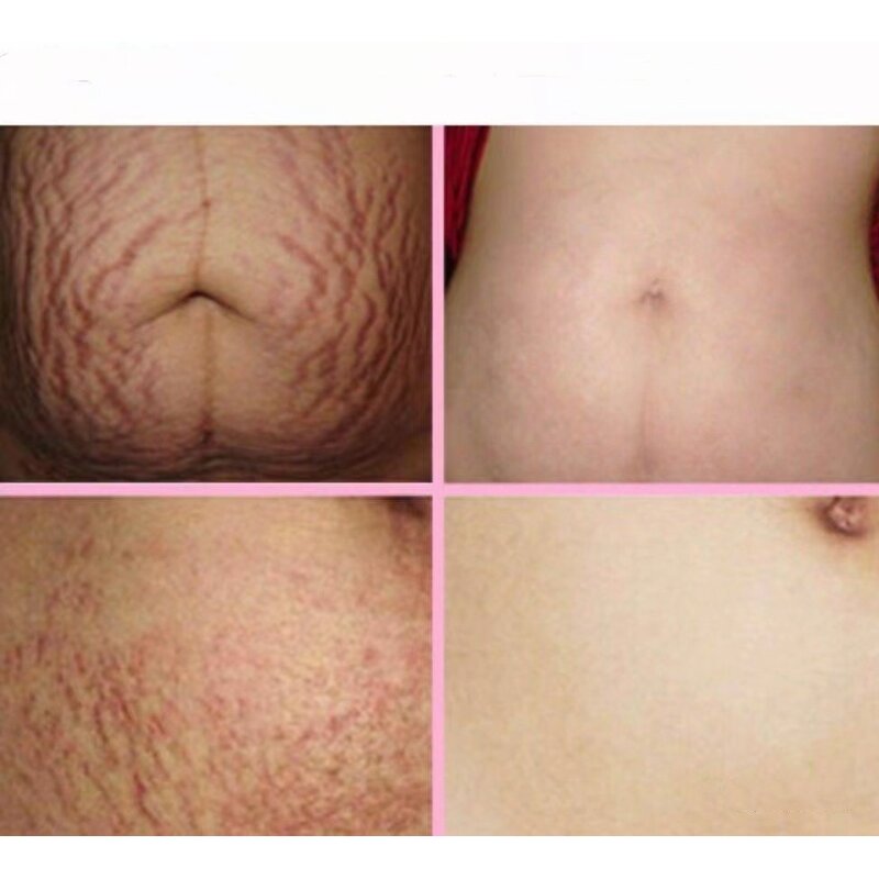 Skin Resurfacing Machine Manufacturer - OEM/ODM GZ Factory Direct Selling CO2 for Acne