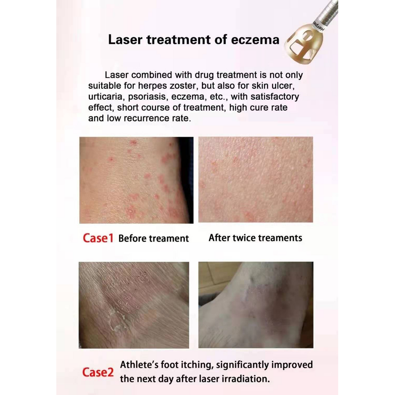 Blood Vessel Removal Machine Factory - 2025y 5 in 1 Medical 980nm Spider Vein