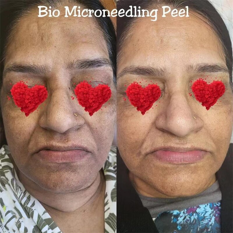 Bio Spicule Sponge Manufacturer - G Microneedle Peel Acne Treatment Non-invasive Algae