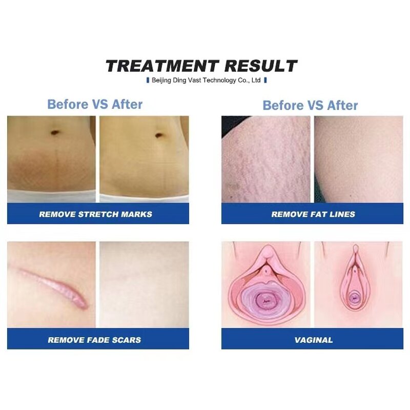 CO2 Fractional Machine Manufacturer - Y for Wrinkle Removal and Acne Scar Removal Pigment