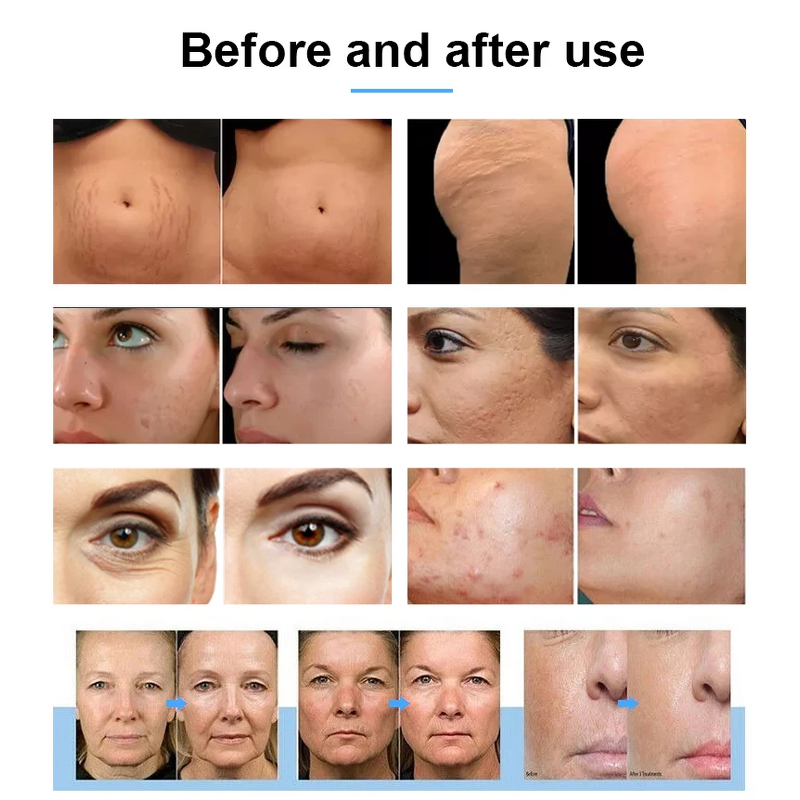 Professional Handheld RF Machine Factory - Face Body Treatment Mesotherapy Wrinkle Removal