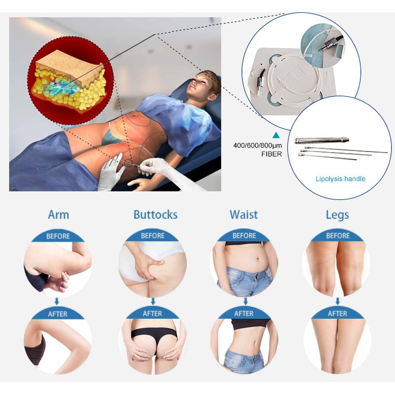 Diode Liposuction Machine Factory - 980nm+1470nm Vaser Lipo Lipolysis Plastic Surgery