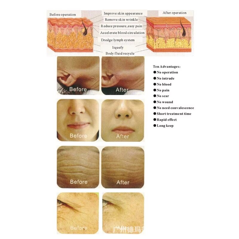 Fat Freeze Device Manufacturer - Best Selling Factory Sale Cryo Weight Loss 8 Handles