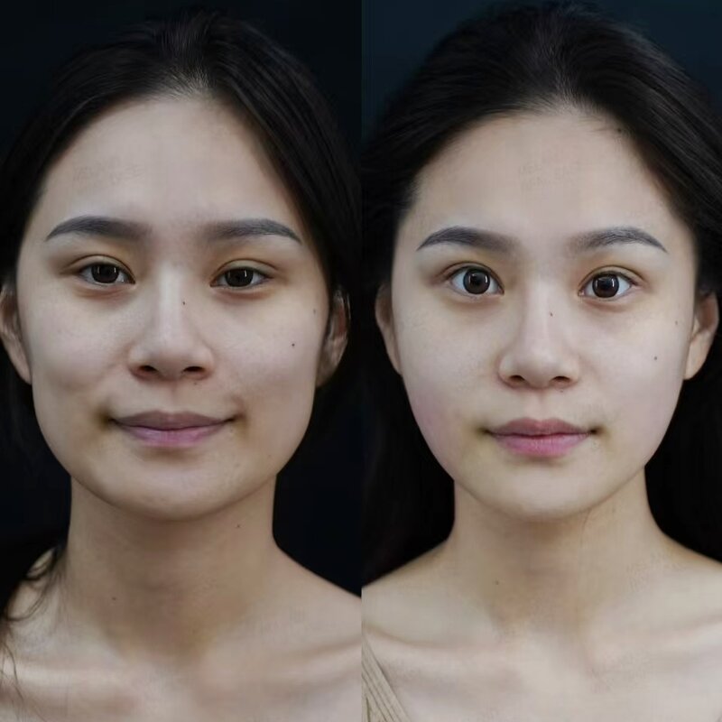 RF Microneedle Machine Manufacturer - G Handheld Fractional Gold Skin Rejuvenation Face Lift