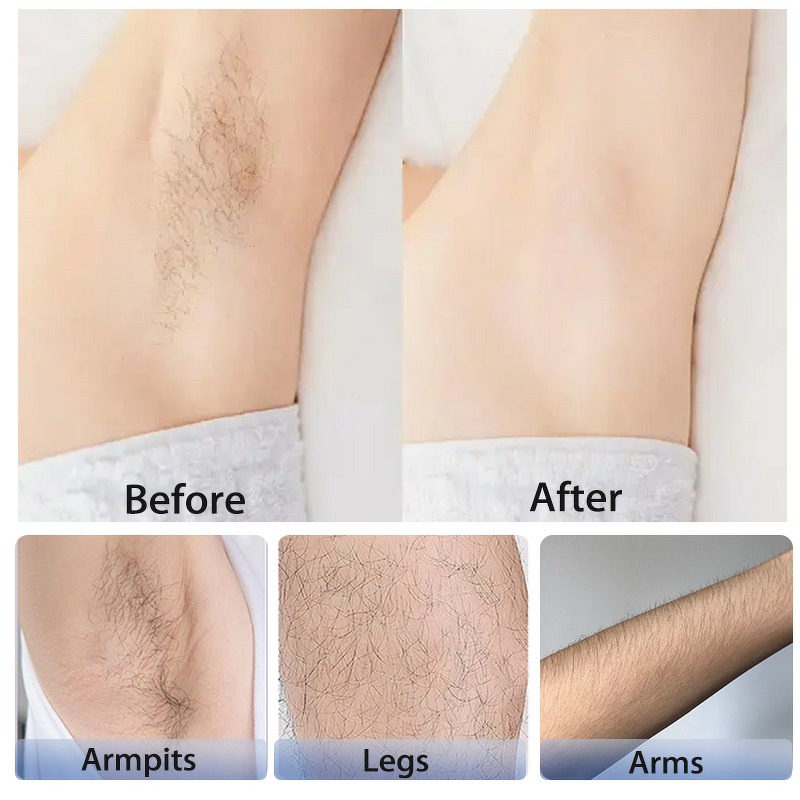 Diode Laser Hair Removal Machine Factory - Hot Sale Aesthetic Medicine 808nm 755nm 1064nm