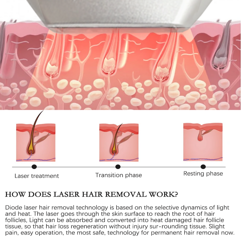 Diode Laser Hair Removal Machine Manufacturer - G Laser Best Professional 755 808 1064nm