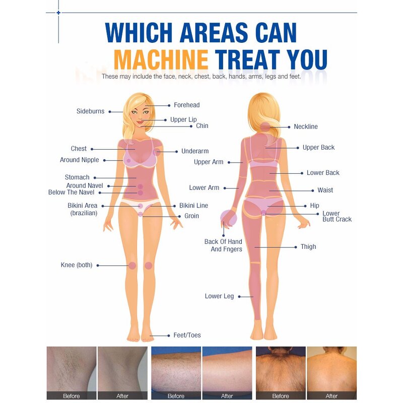 Portable IPL Skin Rejuvenation Device Factory - OPT Hair Removal Salon Use Pulsed Light Ice