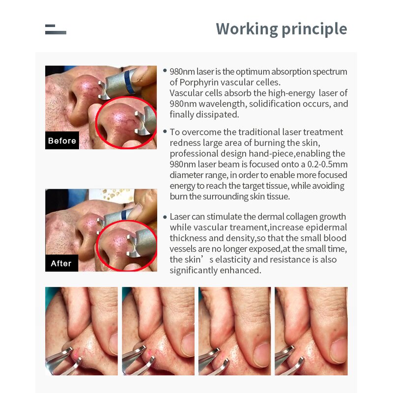 Blood Vessel Removal Machine Factory - 2025y 5 in 1 Medical 980nm Spider Vein