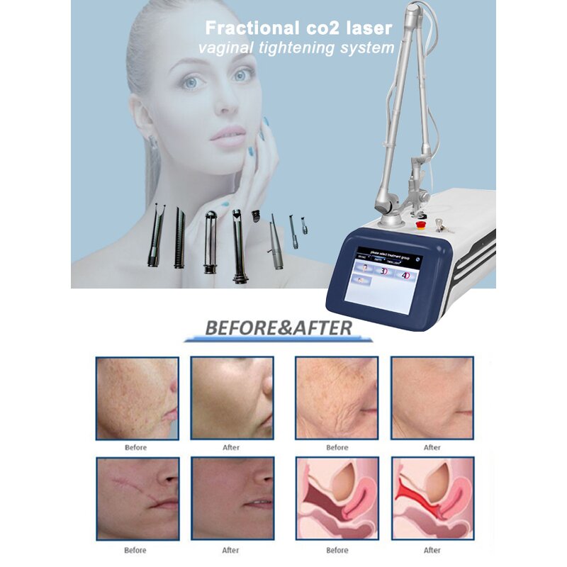 Red Blood Vessel Removal Machine Factory - 980nm 5in1y High Frequency Spider Vein Anti-red