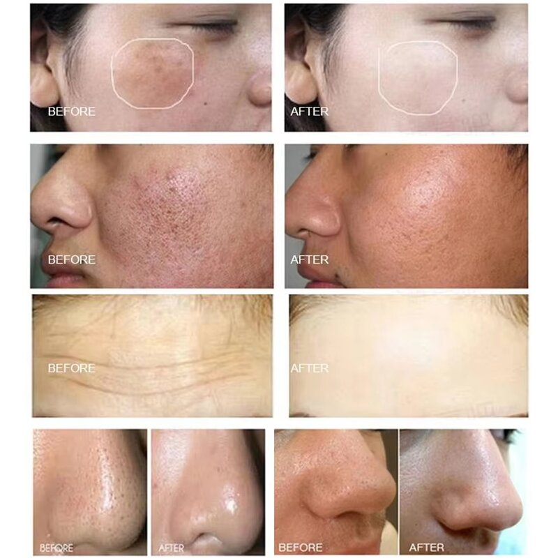 Smart Skin Management Machine Manufacturer - ZS Factory EVA Micro Bubble Oxygen Jet Microdermabrasion