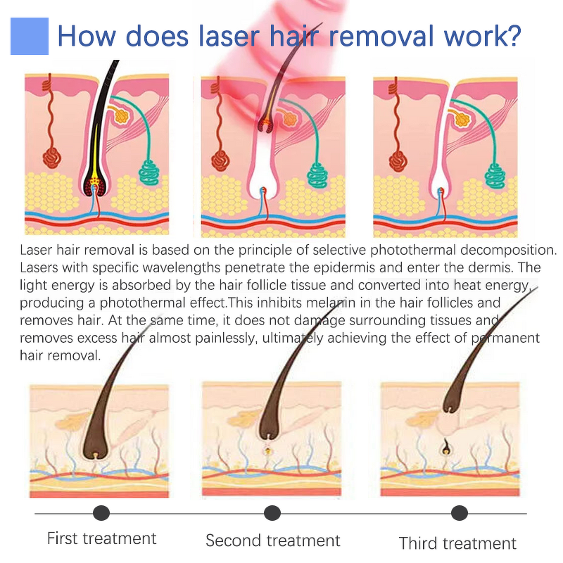 2 in 1 Laser Machine Factory - 2025G 808 Diode Pico Nd Yag Tattoo Removal Hair Removal