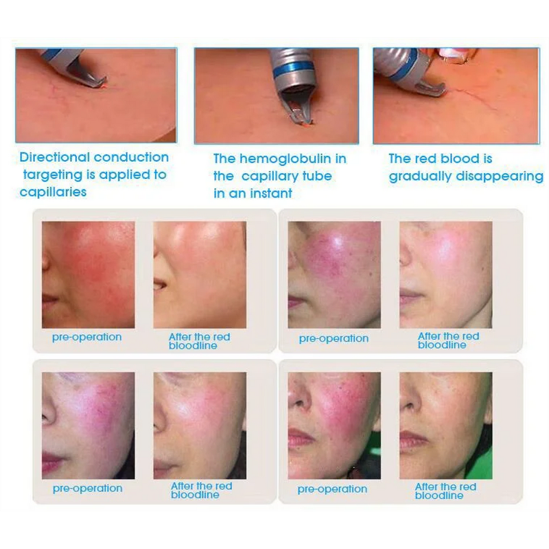 Diode Laser for Vascular Removal Factory - 980nm Spider Vein Removal Blood Laser