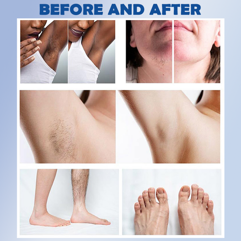 Diode Laser Hair Removal Machine Factory - 2400W 3 Wave 755 808 1064 Price