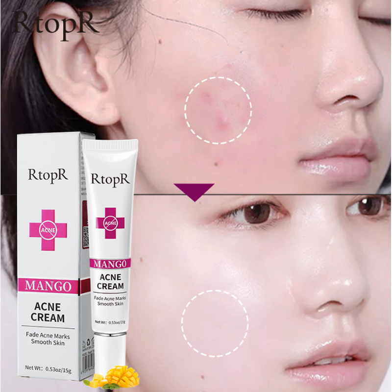 Acne Treatment Cream Manufacturer - RtopR Mango Fade Marks