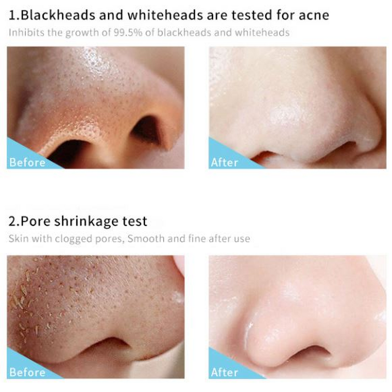 Blackhead Mask Manufacturer - Bamboo Charcoal Absorbing Facial