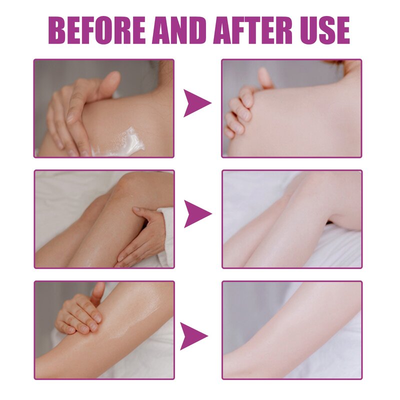 Anti-stretch Mark Cream Manufacturer - Wholesale Best-selling