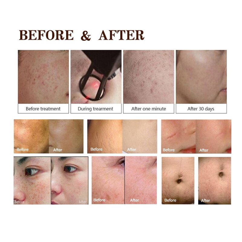 Pico Laser Machine Manufacturer - Long Pulse 450Ps Tattoo Removal