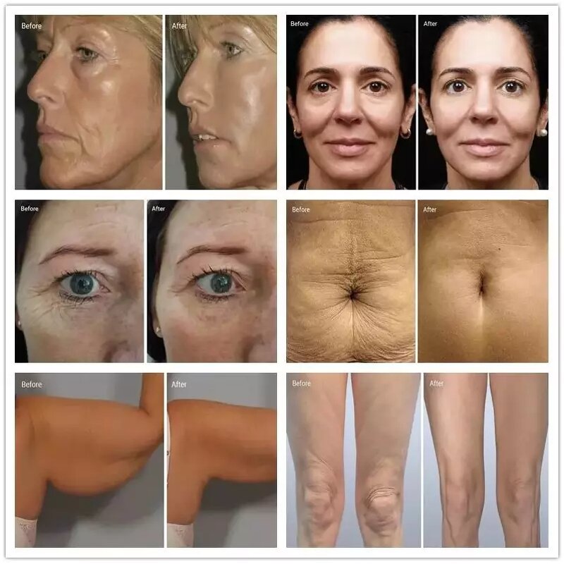 Body Slimming Machine Supplier - Inbody Face Lift Device