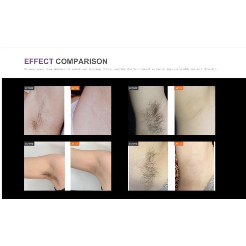 Beauty Machine Supplier - Bulk Factory Price 808nm 1064nm 755nm Diode Laser Beauty Salons