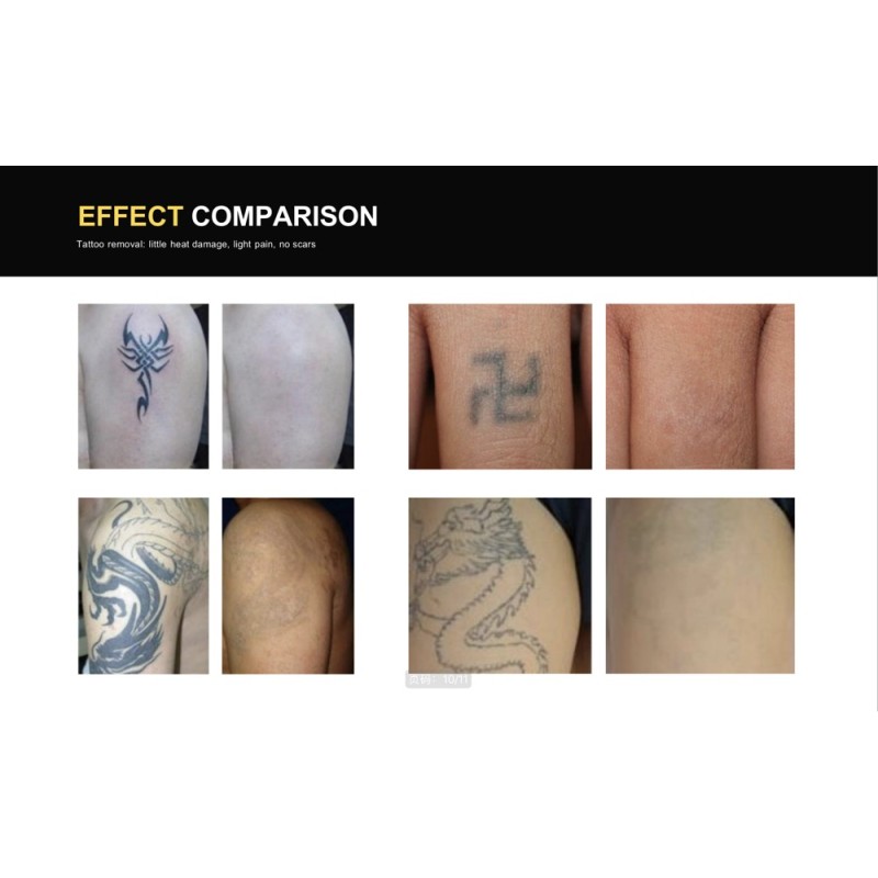 Beauty Machine Supplier - OEM Best Selling Q -switch Laser Tattoo Removal Cooling System