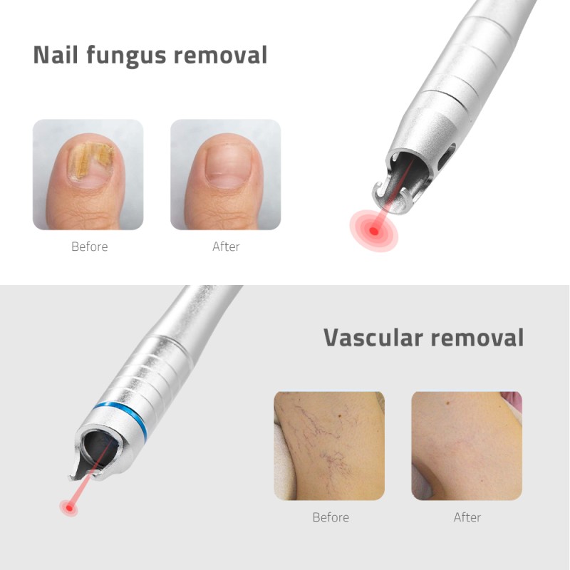Diode Laser Machine Supplier - Bulk 2025 Hot Selling 980nm Nail Fungus Spider Vein Removal
