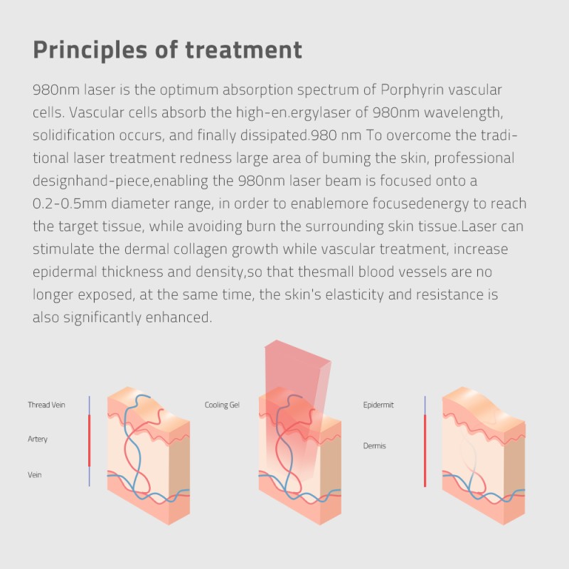 Diode Laser Machine Supplier - Bulk 2025 Hot Selling 980nm Nail Fungus Spider Vein Removal