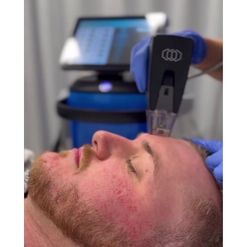 RF Microneedles Manufacturer - OEM 10P 25P 64-P Nano Cartridges Gold Plated Insulated Tips