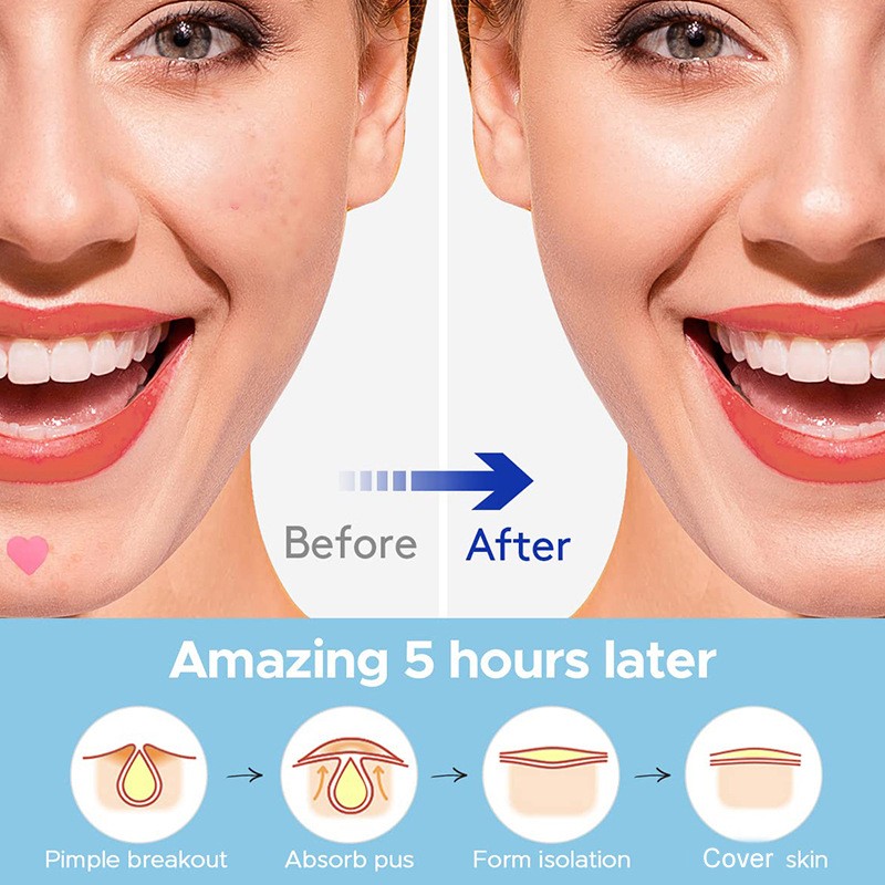 Acne Removal Patch Factory - Bulk Pink Heart Acne Removal Patch Cleansing Closed Comedones