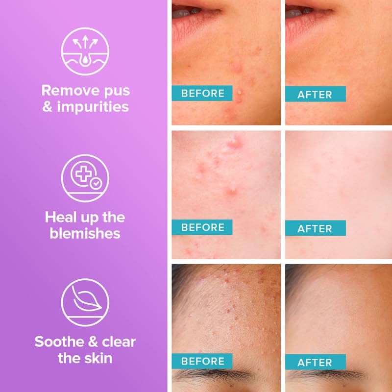 Acne Patch Manufacturer - OEM Pink Heart Acne Patch Custom Hydrocolloid Private Label