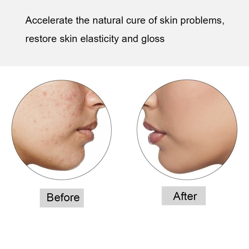 Led Light Pen Supplier - OEM Led Light Pen Microneedle Therapy Beauty Device Wrinkle Removal